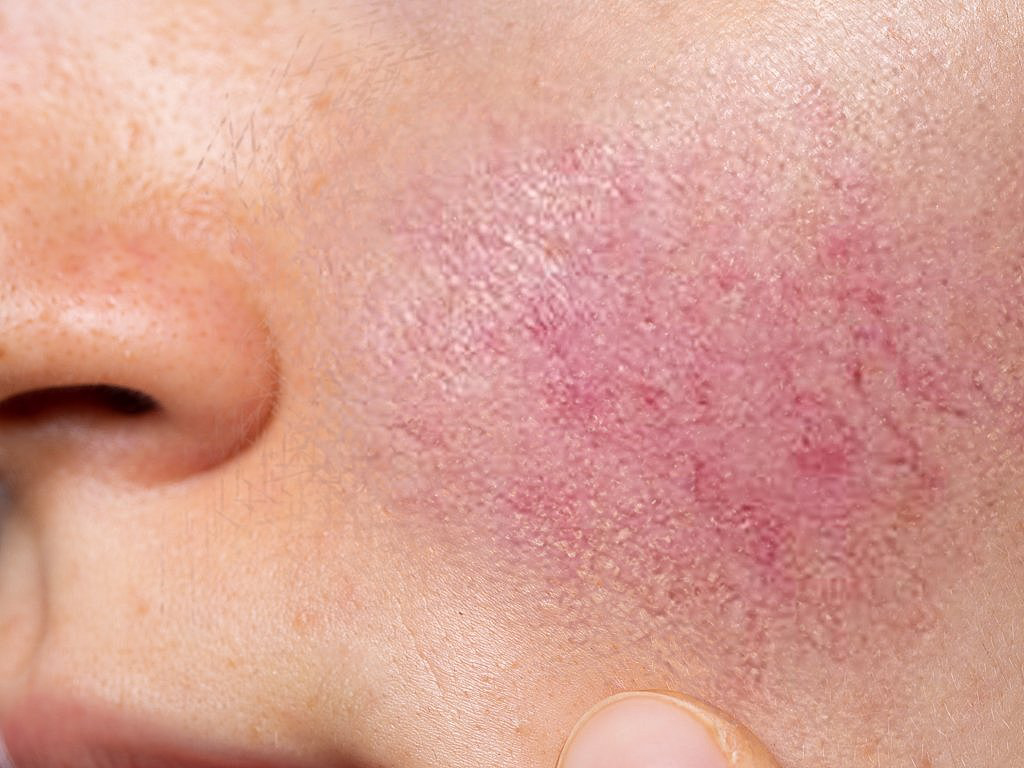 Microbioma piel brotes